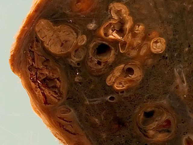 Paragonimiasis infection of the lung