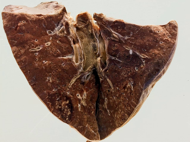 Influenzal bronchopneumonia