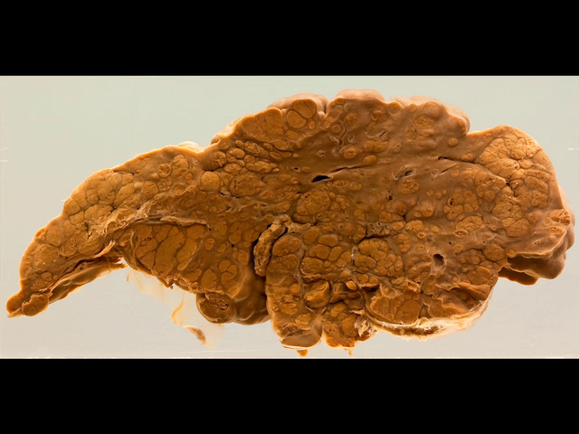 Cirrhosis (post viral hepatitis)
