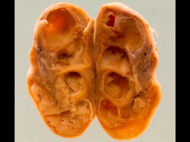Gonococcal salpingo-oophoritis