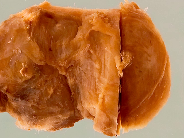 Onchocercal nodule