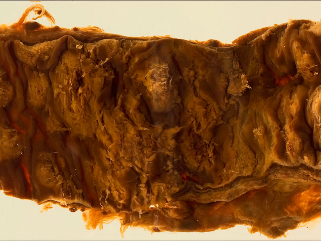 Amoebiasis (Colon)