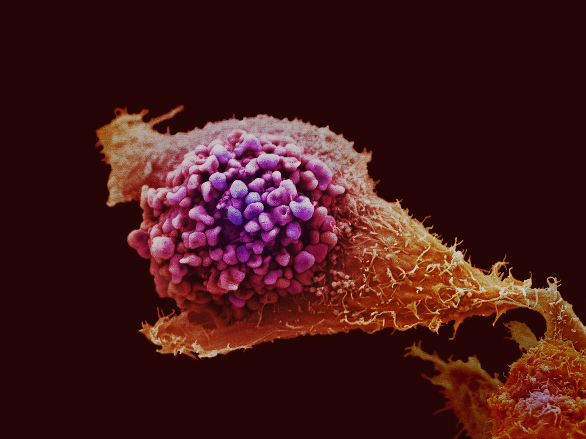 Prostate cancer cell imaged using electron microscopy and coloured artificially