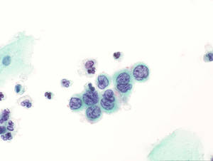 Cervical Smear