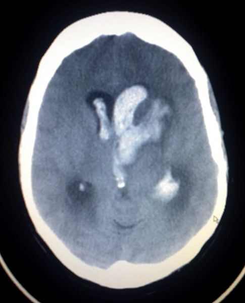 This image shows an Intracerebral and Intraventriclar haemorrhage of a young woman. The woman was one week post partum, with no known trauma involved.