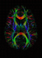 Diffusion Tensor Imaging (DTI) image