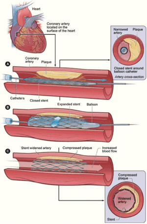 Coronary angioplasty and stent 