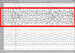 EEG - slow wave sleep