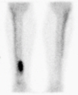 Figure 5 - A bone scan reveals a fracture in this athlete's leg, in which the Xray was normal