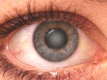 The lens shows fogging characteristic of cataract formation.