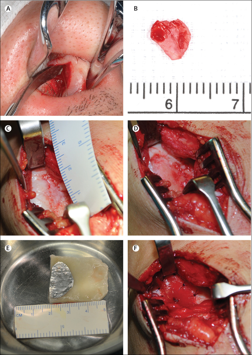  A, B) Harvesting of a cartilage biopsy from the patient, under local anaesthesia. (C) Exposure of the full thickness cartilage defect of the lateral femoral condyle via mini-arthrotomy. (D) Refreshing of the cartilage lesion to remove the damaged...