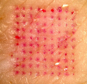 Pig cadaver skin after insertion and removal of microneedles