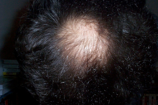 A bald patch