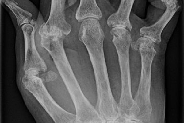 Rheumatoid Arthritis x-ray