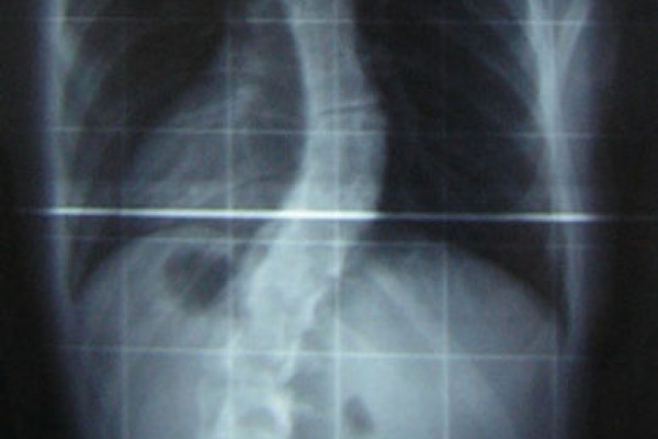 An X-ray of the spine of a patient with scoliosis