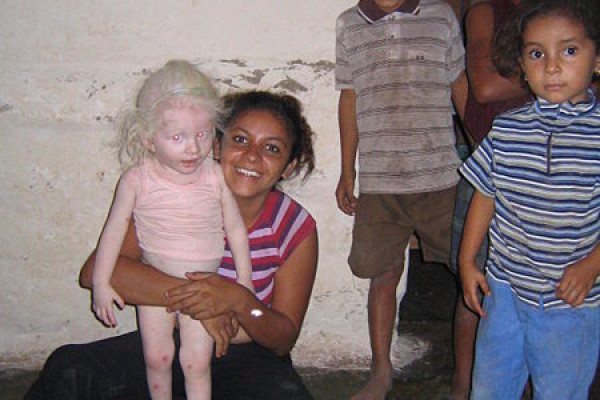 A albino girl in Honduras.