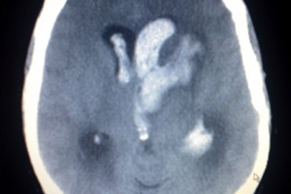 This image shows an Intracerebral and Intraventriclar haemorrhage of a young woman. The woman was one week post partum, with no known trauma involved.