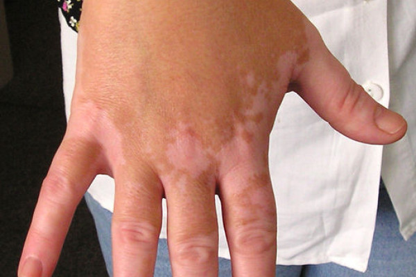 Vitiligo