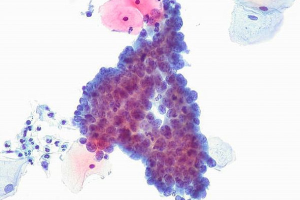 Cytological specimen (ThinPrep) from a patient who was later diagnosed with cervical adenocarcinoma in situ. There is at least one mitosis.