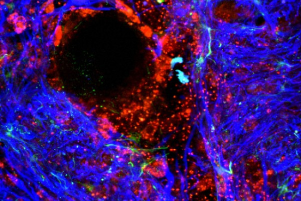 Damaged blood-brain barrier