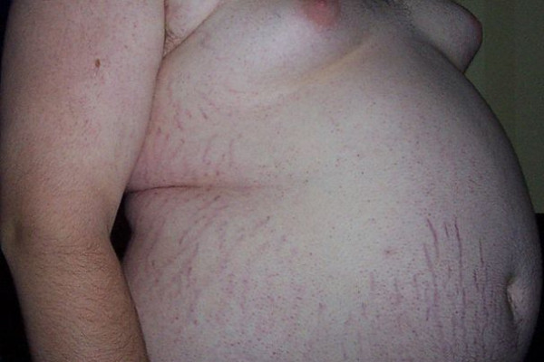 Picture of an Obese Teenager (146kg/322lb) with Central Obesity, side view