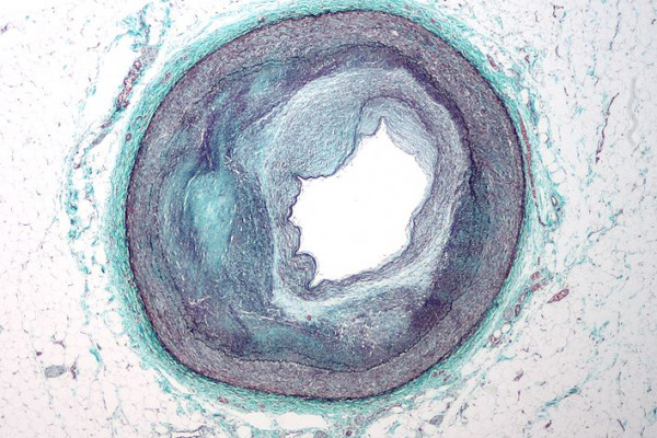 Low magnification micrograph of the distal right coronary artery with complex atherosclerosis and luminal narrowing. Stained with Masson's trichrome.