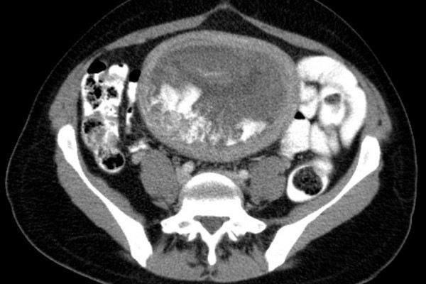 Hydatidiform mole on CT, axial view