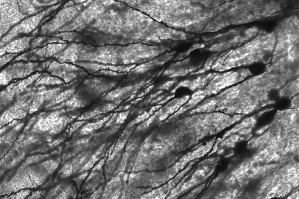 Image of Golgi stained neurons in the dentate gyrus of an epilepsy patient. 40 times magnification.