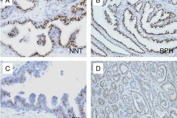  Immunohistochemical expression of p501s on benign and malignant epithelium of prostate and non-prostatic tissues. A. Non-neoplastic prostatic tissue adjacent to malignant glands (NNT). B. Benign prostatic hyperplasia. C. High-grade prostatic...
