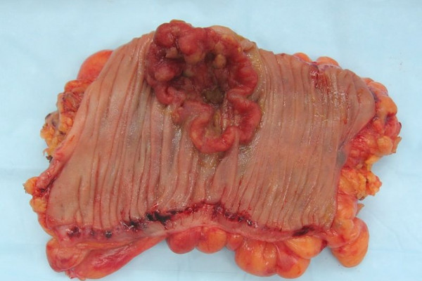 Appearance of the inside of the colon showing one invasive colorectal carcinoma (the crater-like, reddish, irregularly shaped tumor).
