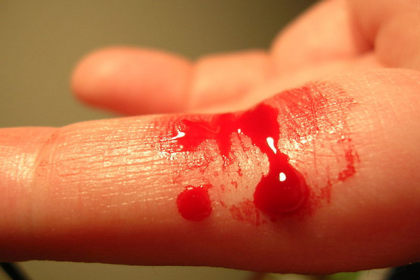 Bleeding finger