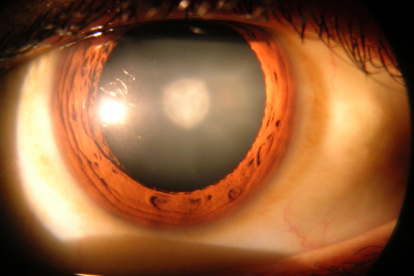 Cataract in Human Eye