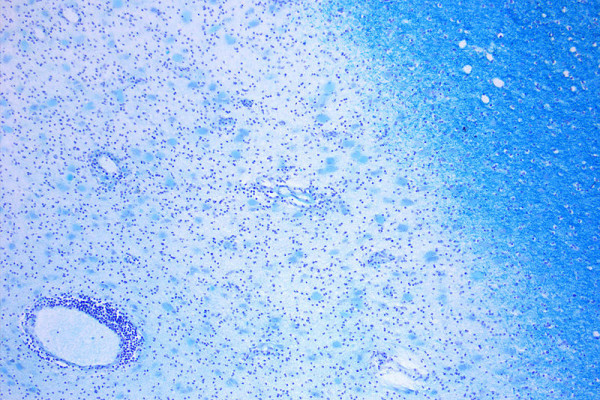 Photomicrograph of a demyelinating MS-Lesion. Klüver-Barerra-Stain. Orgininal Magnification 10x