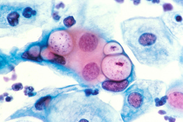 Human cervical pap smear showing clamydia in the vacuoles at 500x and stained with H&E.