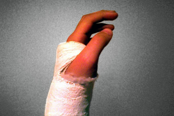Plaster cast on forearm/wrist/hand