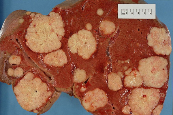 Cross section of a human liver, taken at autopsy examination, showing multiple large pale tumour deposits. The tumour is an adenocarcinoma derived from a primary lesion in the body of the pancreas.