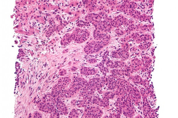  Low magnification micrograph of a metastatic adenocarcinoma to the liver. Liver biopsy. H&E stain. The adenocarcinoma (lower two-thirds of the image) is moderately differentiated; morphologically, it consists of poorly formed glands and is surrounded...