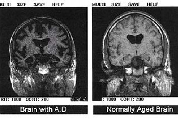 Two transaxial slices through the head. The right image shows a normal brain; the left has differences that are interpreted as indication of Alzheimer's disease