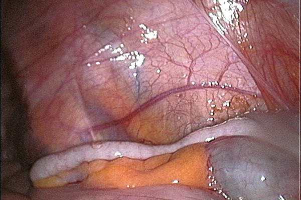 vermiform appendix