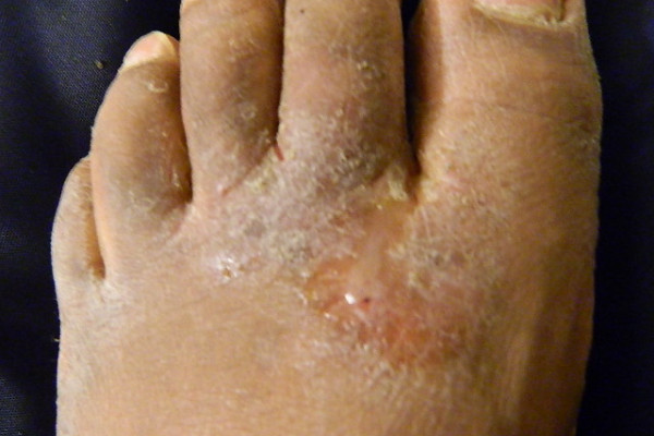 Athlete's foot fungal infection