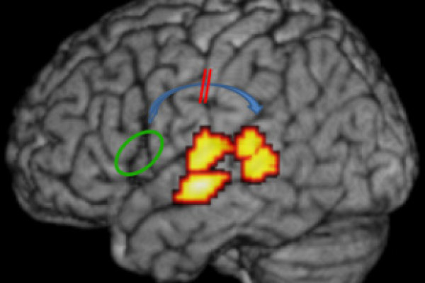 The arcuate fasciculus connecting frontal and temporal language areas of the brain (shown in blue) is impaired in individuals with dyslexia. (Image: Bart Boets, Leuven University).