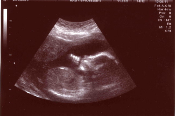 Foetus in ultrasound