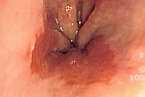 Endoscopic image of Barrett's esophagus