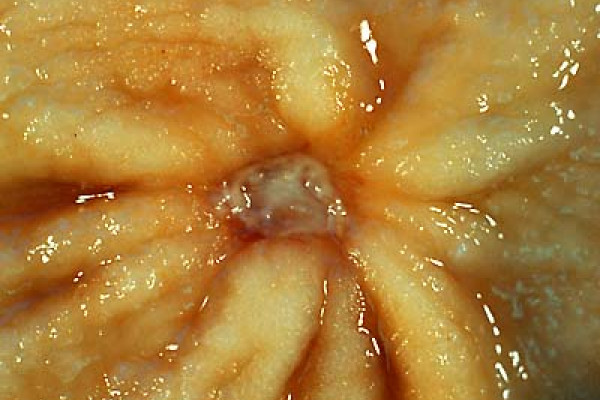 Benign Gastric Ulcer