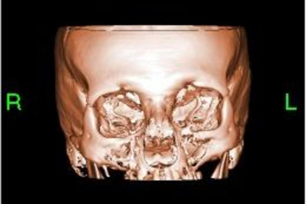 Bone reconstructed in 3D