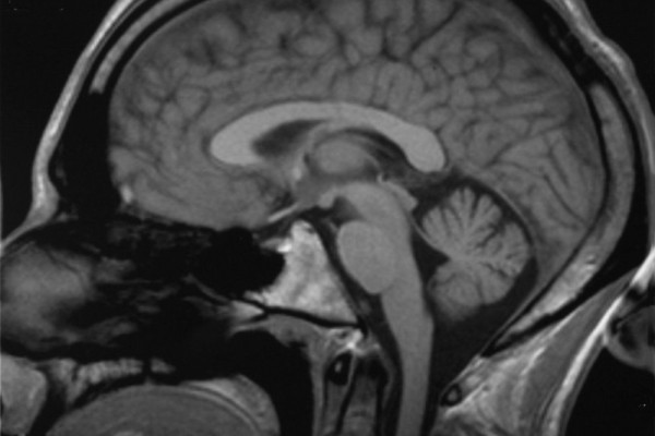 Saggital transection through the human brain