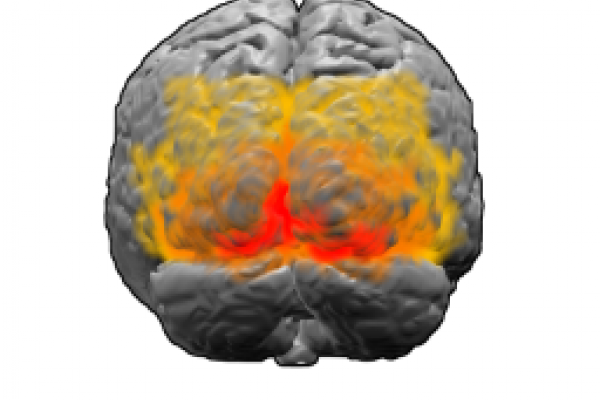  Brodmann areas 17, 18 and 19. BA 17 is shown in red. BA 18 is orange. BA 19 is yellow. This is a rear view of the brain. Much of BA 17 is hidden from view on the medial surface (between the hemispheres), on the ventral bank of the calcarine sulcus...