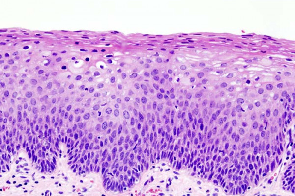 Cervical Intraepithelial Neoplasia CIN2