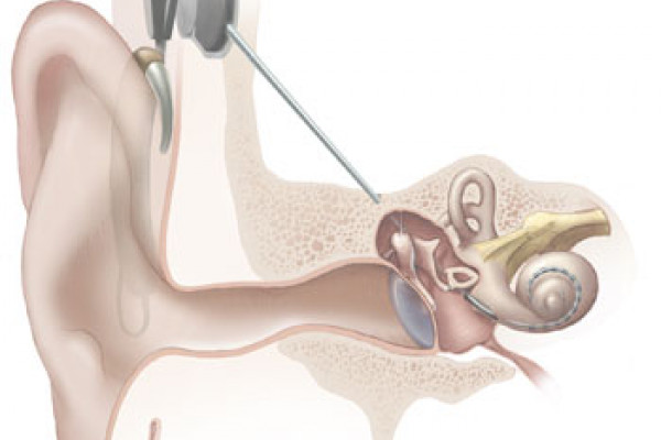 Illustration of cochlear implant from the National Institute on Deafness and Other Communication Disorders at the National Institutes of Health.