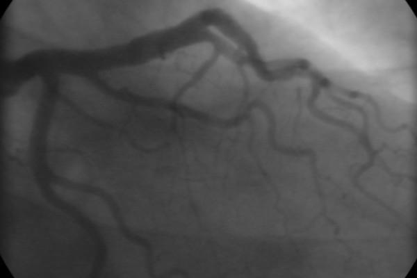The coronary angiogram (LCA) of a man.